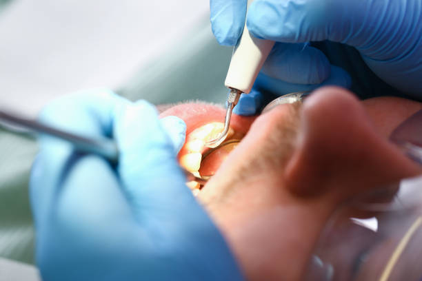 Best Emergency Dental Care for Broken or Chipped Teeth in Casselton, ND